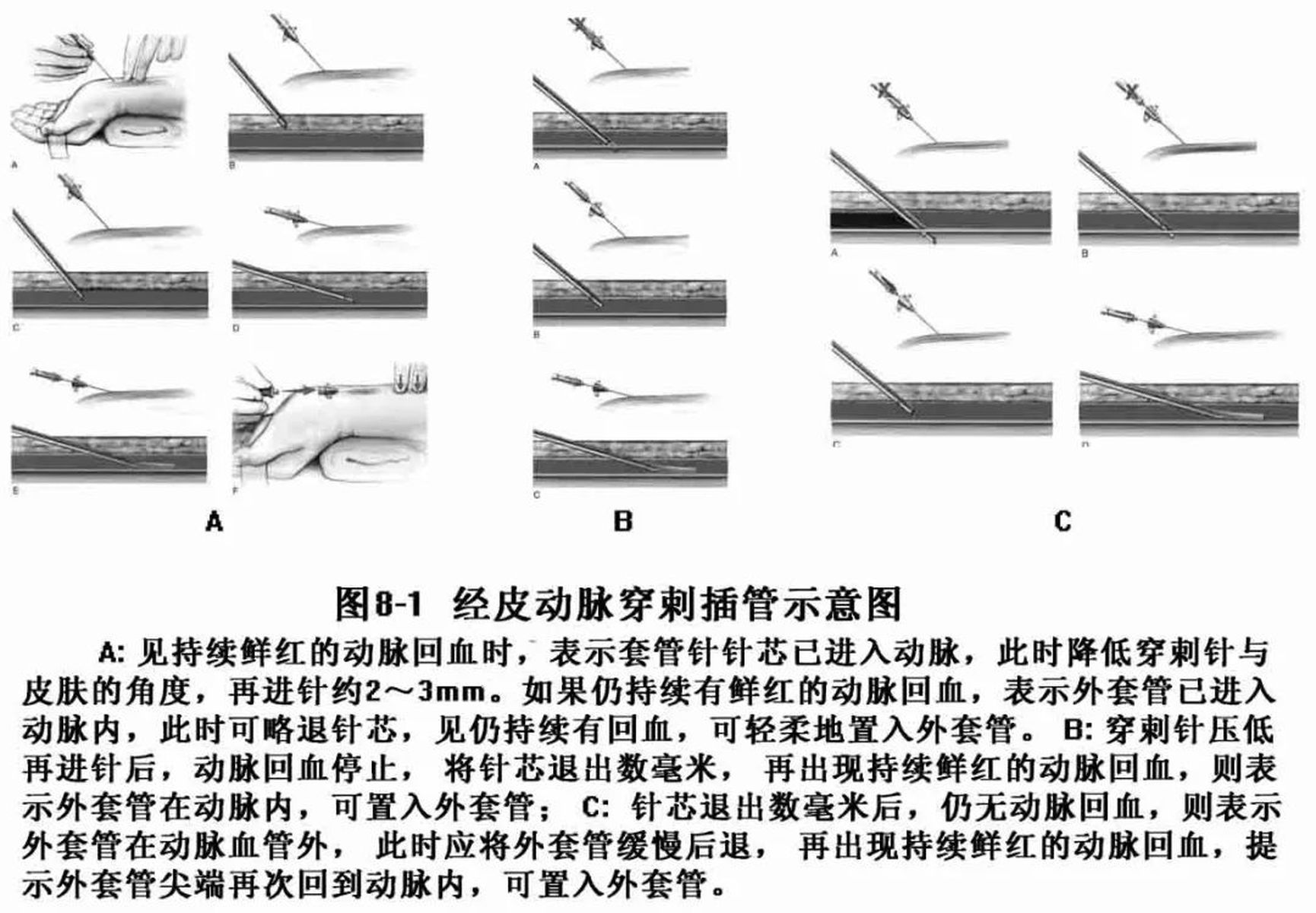 橈動(dòng)脈穿定位法最新步驟指南與操作解析